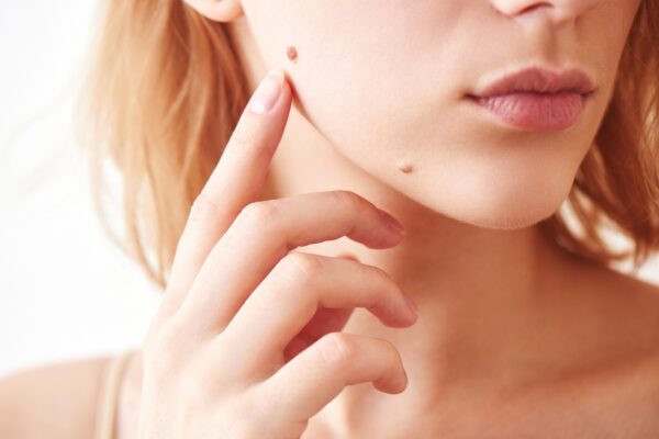 Cosmetische dermatologie bij Mauritskliniek
