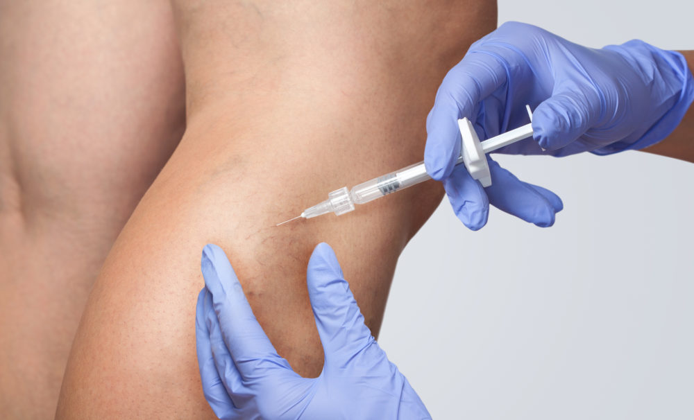 Sclerocompressietherapie behandeling Mauritskliniek