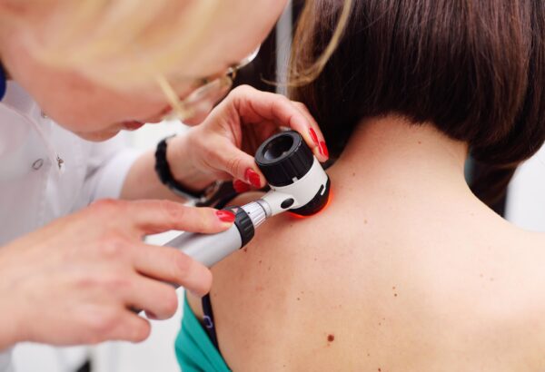 Dermatoscoop huidcontrole Mauritskliniek