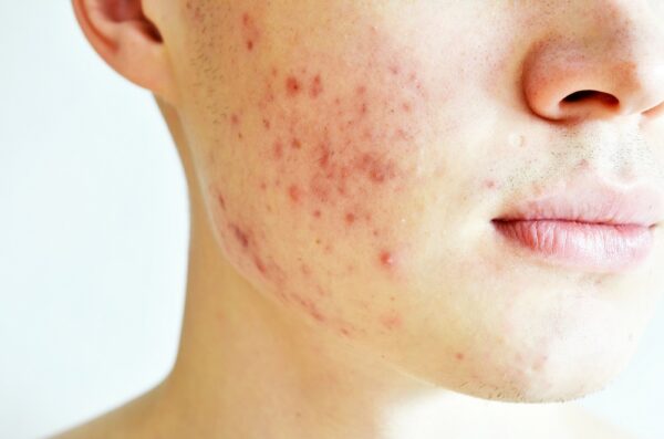 Acne behandeling Mauritskliniek