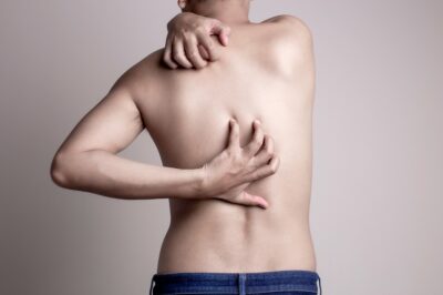 Dermatologie | Constitutioneel Eczeem - Mauritskliniek